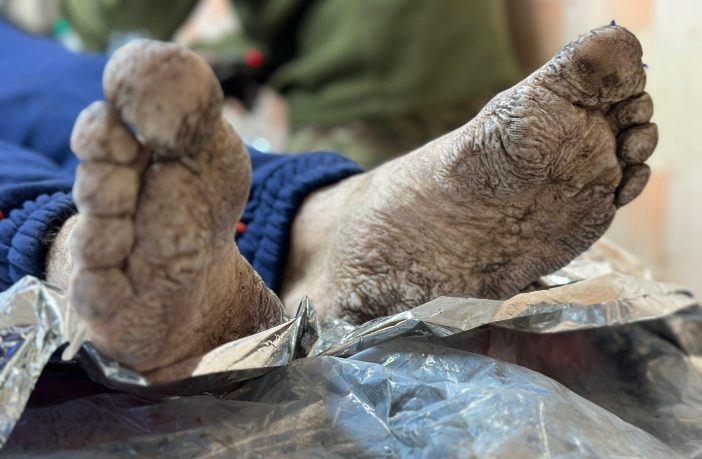 окопної хвороби