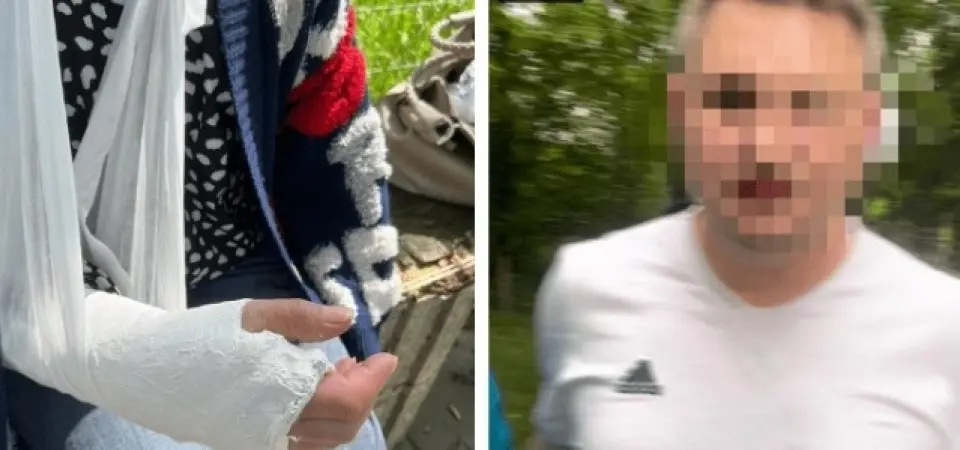 зламав руку