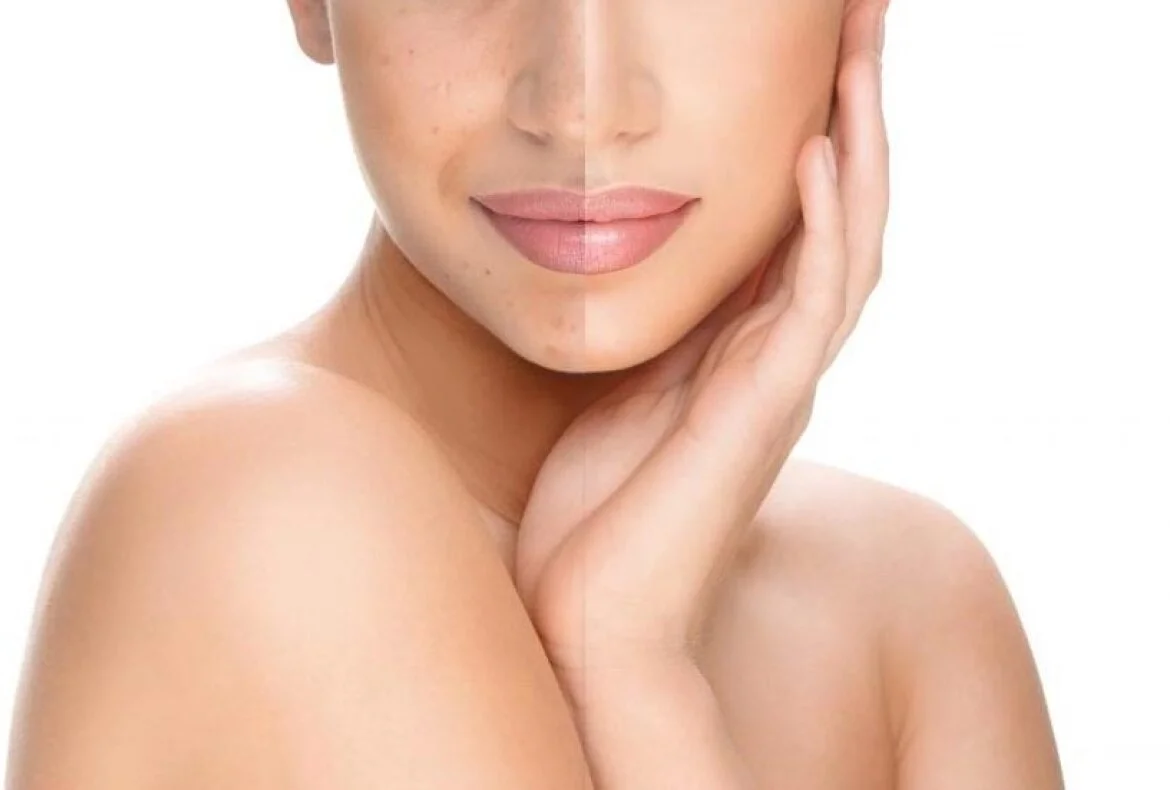 lazernoe omolozhenie 3