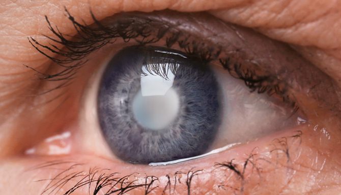 Лікування катаракти