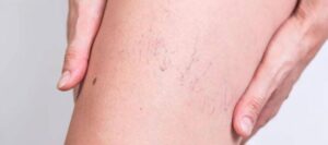 Судинні зірочки