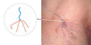 Судинні зірочки